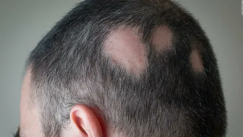 hair fall during pregnancy