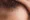 Pictures of Frontal Fibrosing Alopecia