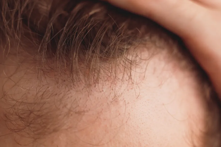 Pictures of Frontal Fibrosing Alopecia