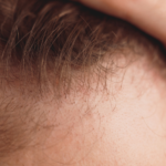 Can Frontal Fibrosing Alopecia Be Reversed