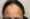 Can You Get a Hair Transplant with Frontal Fibrosing Alopecia?