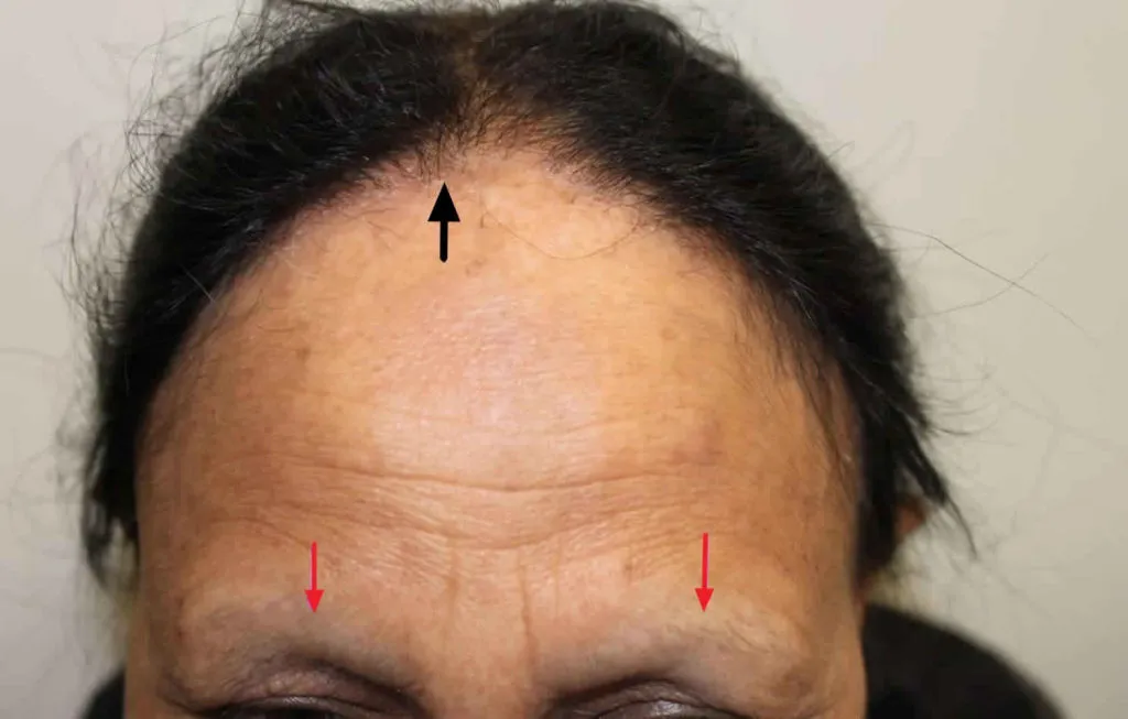 Can You Get a Hair Transplant with Frontal Fibrosing Alopecia?