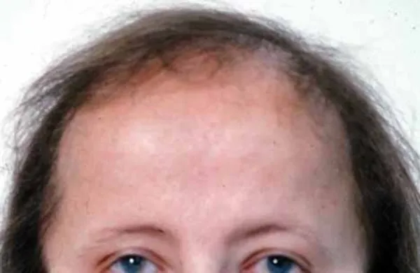 What Autoimmune Disease Causes Frontal Fibrosing Alopecia