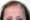 How Long Does Frontal Fibrosing Alopecia Last?