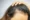 Can you get a hair transplant with frontal fibrosing alopecia?