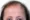 Pictures of Frontal Fibrosing Alopecia