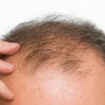 Person experiencing hair thinning, exploring the effects of glutathione hair loss and regrowth