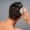 alopecia areata lotion