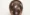  Early Frontal Fibrosing Alopecia 