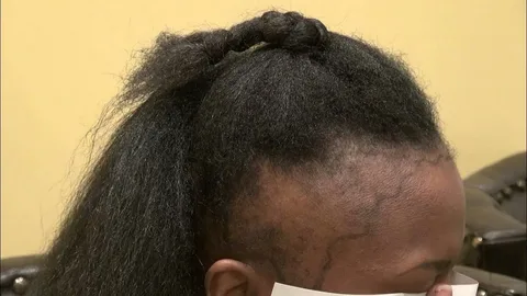how LDN for hair loss