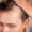 how to stop receding hairline