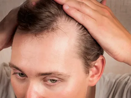 Pygeum for hair loss
