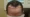 how to stop receding hairline