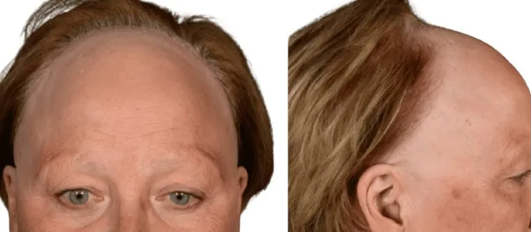 Is frontal fibrosing alopecia an autoimmune disease?