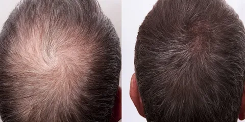 Blood Pressure and Hair Loss