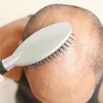 just for men hair loss