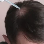 potential side effects of hair cloning