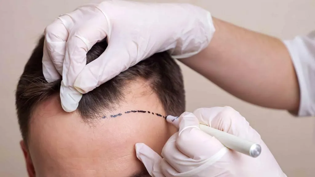 Can You Get a Hair Transplant with Frontal Fibrosing Alopecia?