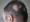 an Alopecia Areata Be Reversed