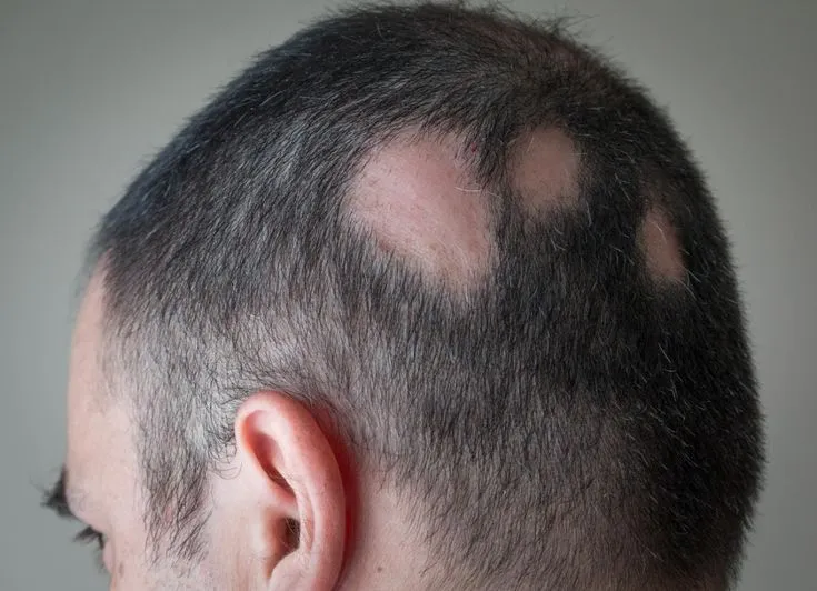 an Alopecia Areata Be Reversed