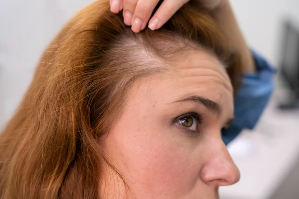 Does Frontal Fibrosing Alopecia Itch?