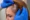how do you get tested for alopecia