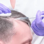 PRP for Hair Loss in San Diego