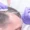 ldn hair loss