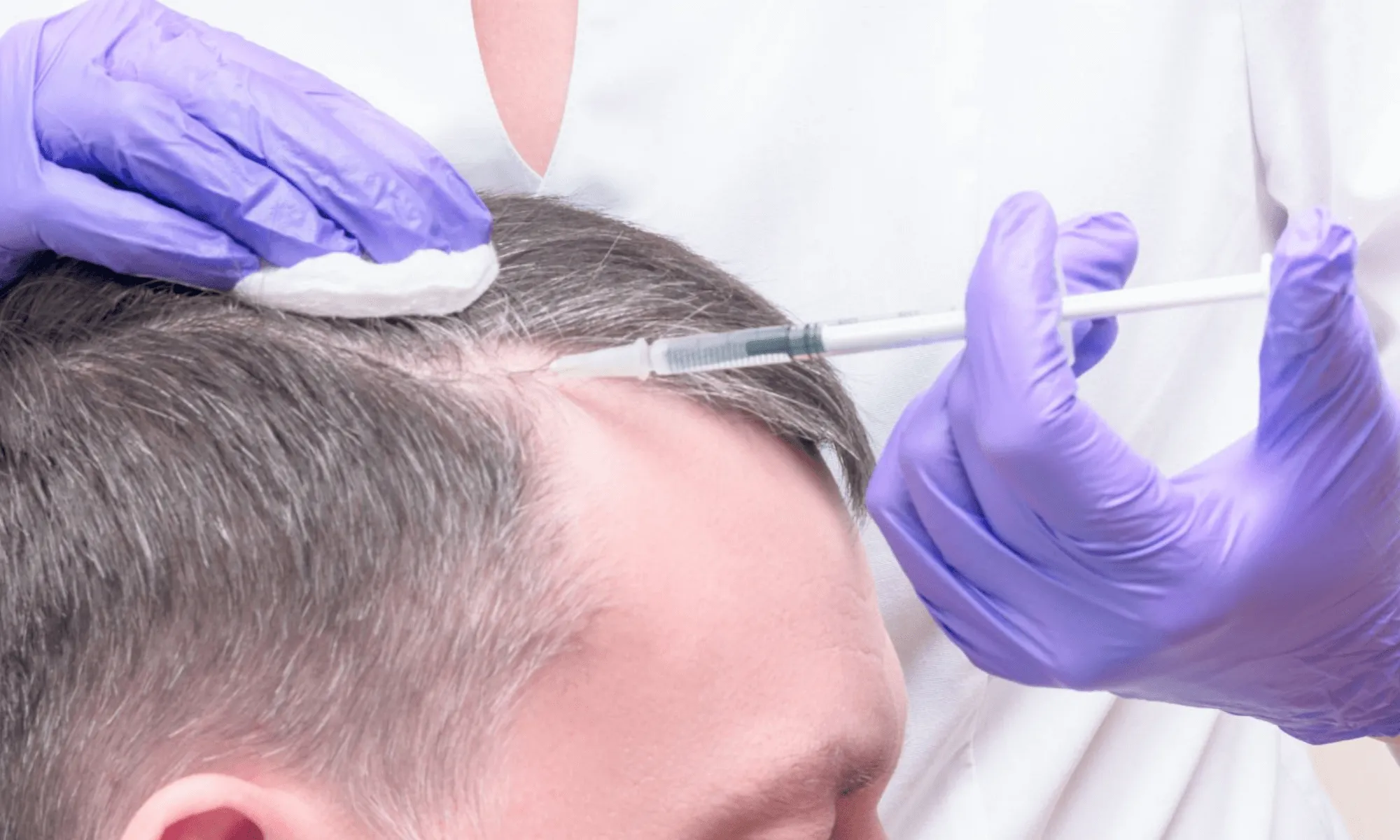 PRP for Hair Loss in San Diego