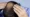 ldn hair loss