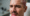 Sweat After a Hair Transplant