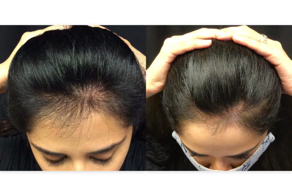 Does Nutrafol cause hair loss