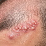 Shingles Hair Loss