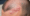 Shingles Hair Loss