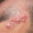 Shingles Hair Loss