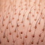 hair transplant donor area regrowth