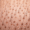 hair transplant donor area regrowth