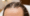 Acupuncture for Hair Loss