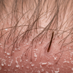 Can Dry Scalp Lead to Hair Loss