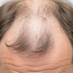 Which Medication Helps Alopecia Areata