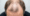 Hair Loss on Semaglutide