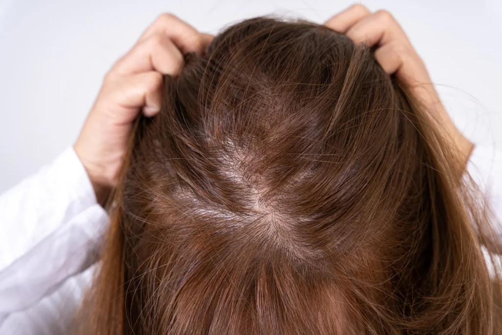 Can Highlighting Hair Cause Hair Loss