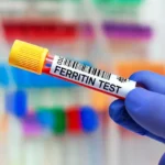 Can High Ferritin Cause Hair Loss