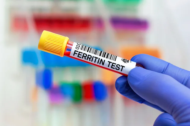 Can High Ferritin Cause Hair Loss