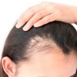 Low Cortisol Cause Hair Loss
