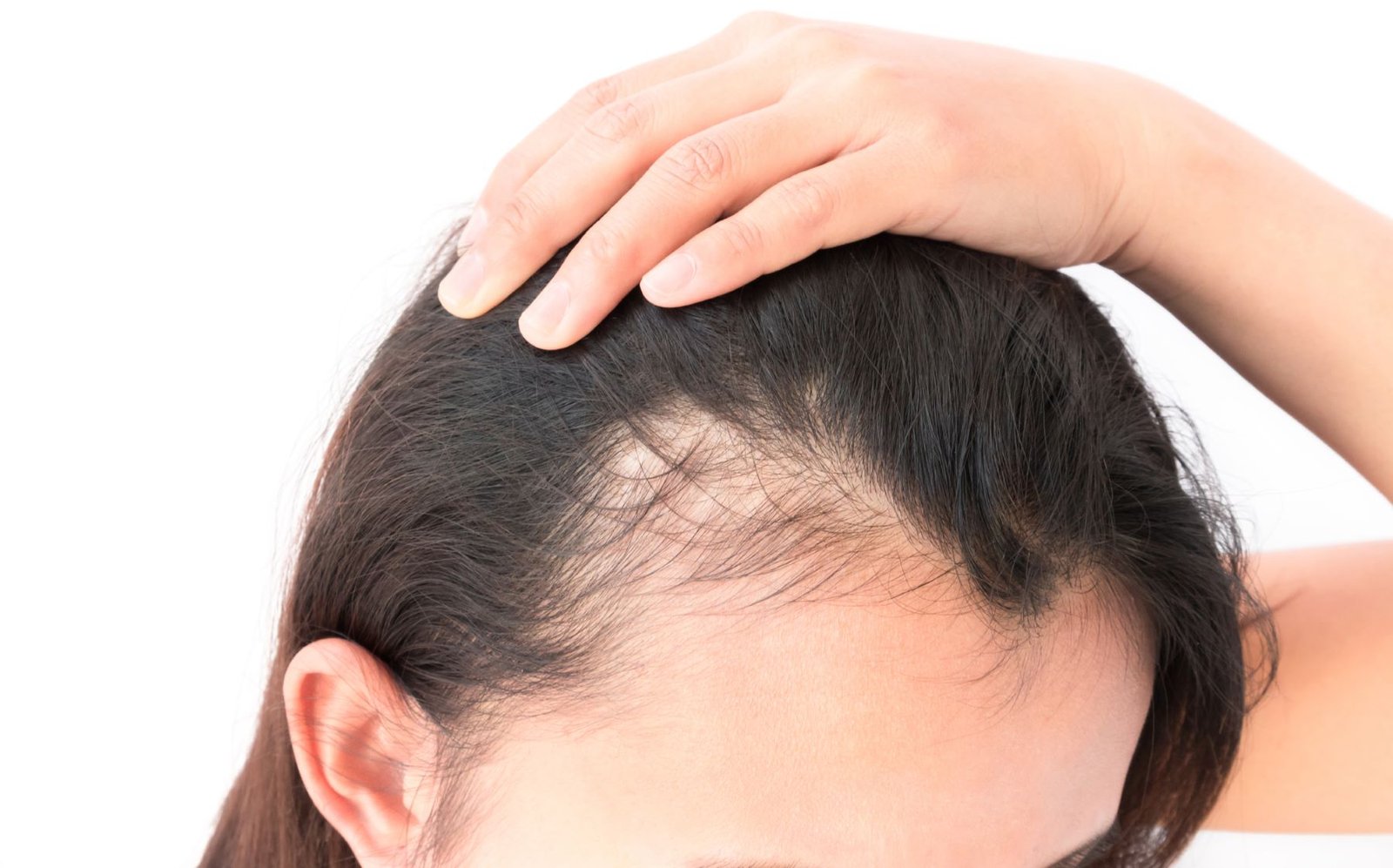 Low Cortisol Cause Hair Loss