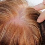 Can Highlighting Hair Cause Hair Loss