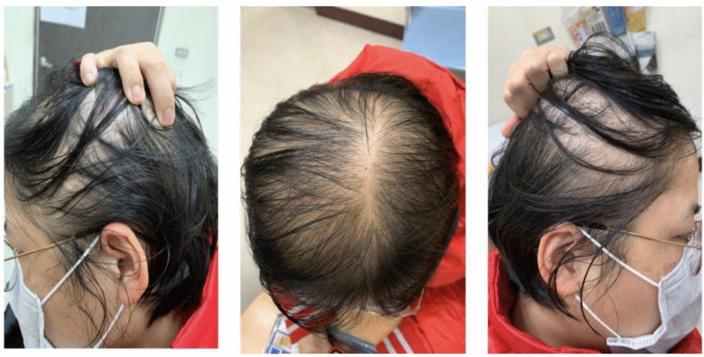 Can Highlighting Hair Cause Hair Loss