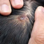 Can Herpes Cause Hair Loss