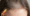 Hair Loss with Celiac Disease